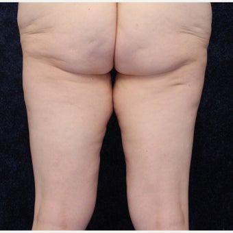 36 year old woman treated with Medial Thigh Lift and Beltlift 1642346