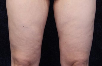 36 year old woman treated with Medial Thigh Lift and Beltlift after 1642346