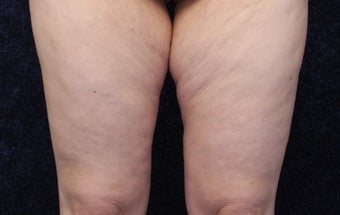 36 year old woman treated with Medial Thigh Lift and Beltlift before 1642346