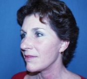 Facelift after 1130944