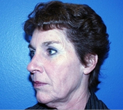 Facelift before 1130944