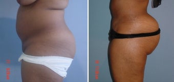 25-34 year old woman treated with Brazilian Butt Lift before 3174368