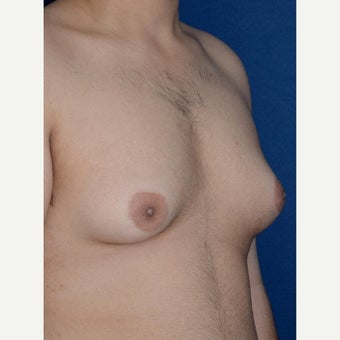 Male Breast Reduction using BodyTite liposuction for stubborn gynecomastia 1994195