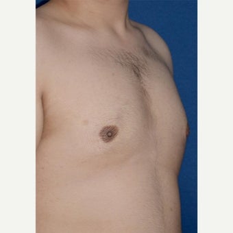 Male Breast Reduction using BodyTite liposuction for stubborn gynecomastia 1994195