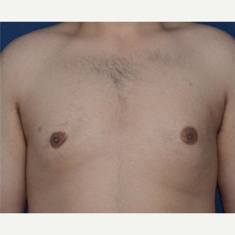 Male Breast Reduction using BodyTite liposuction for stubborn gynecomastia after 1994195