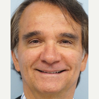 55-64 year old man treated with Acne Scars Treatment before 3727578