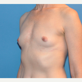 Breast Augmentation before 3783434