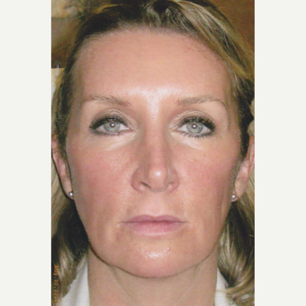51 year old woman treated with Sculptra, HA Filler, Neurotoxin, Soft Lift before 3055329