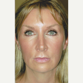 51 year old woman treated with Sculptra, HA Filler, Neurotoxin, Soft Lift after 3055329
