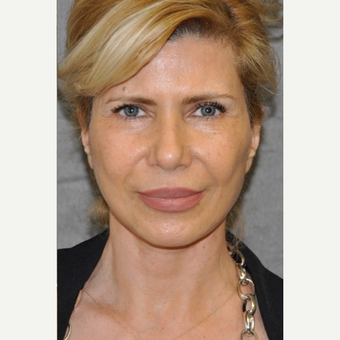 45-54 year old woman treated with Facelift after 3004646