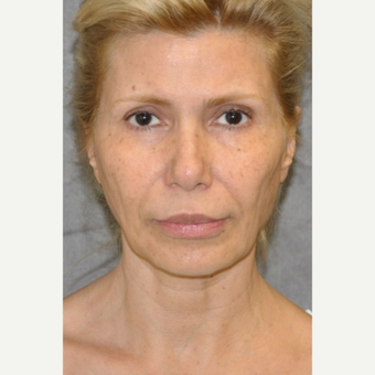 45-54 year old woman treated with Facelift before 3004646