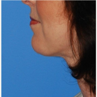 35-44 year old woman treated with Chin Implant & Neck Lift after 3649798