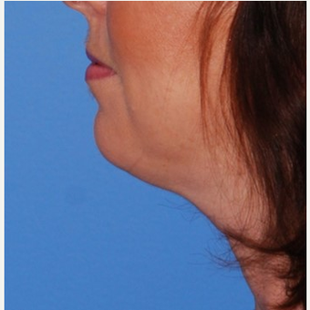 35-44 year old woman treated with Chin Implant & Neck Lift before 3649798