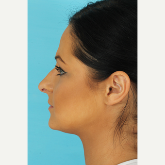 25-34 year old woman treated with Rhinoplasty before 3691266