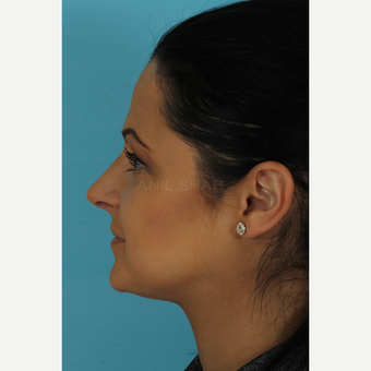 25-34 year old woman treated with Rhinoplasty after 3691266