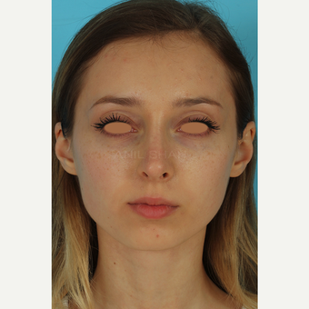 25-34 year old woman treated with Rhinoplasty before 3628989