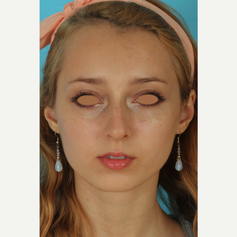 25-34 year old woman treated with Rhinoplasty after 3628989