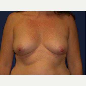 25-34 year old woman treated with Breast Augmentation before 3220119