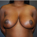 23 year old female underwent breast reduction for back pain after 3570318