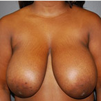 23 year old female underwent breast reduction for back pain before 3570318