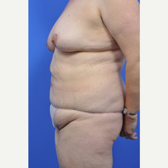 35-44 year old woman treated with Body Lift before 3442385