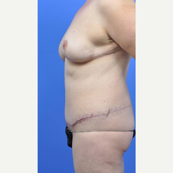 35-44 year old woman treated with Body Lift after 3442385