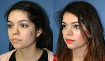22 Year Old Female, primary Rhinoplasty after 966053