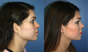 22 Year Old Female, primary Rhinoplasty 966053