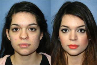 22 Year Old Female, primary Rhinoplasty before 966053
