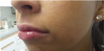 25-34 year old woman treated with Lip Augmentation - Juvederm Ultra 3191298