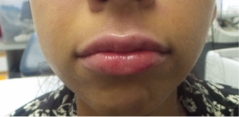 25-34 year old woman treated with Lip Augmentation - Juvederm Ultra after 3191298