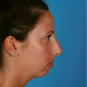 18-24 year old woman treated with Chin Surgery before 3458146