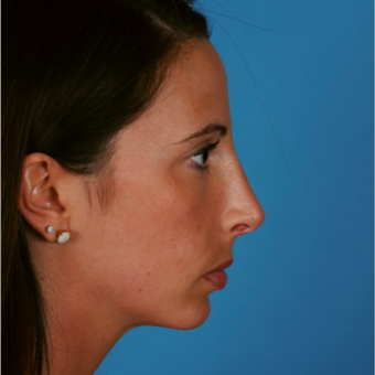 18-24 year old woman treated with Chin Surgery after 3458146