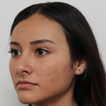 17 or under year old woman treated with Rhinoplasty after 3418790
