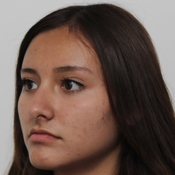 17 or under year old woman treated with Rhinoplasty before 3418790