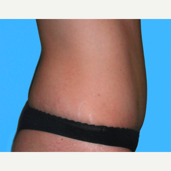 Tummy Tuck after 3813508