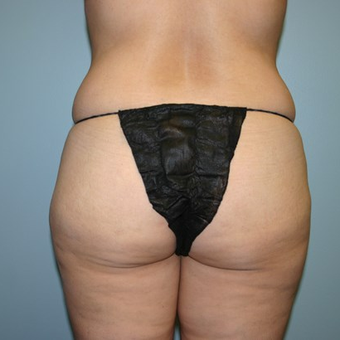 Brazilian Butt Lift before 3667482