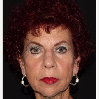 65-74 year old woman treated with Radiesse before 3067534