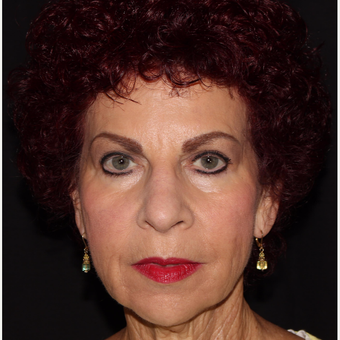 65-74 year old woman treated with Radiesse after 3067534