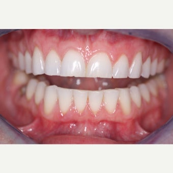 35-44 year old woman treated with Porcelain Veneers before 1833267