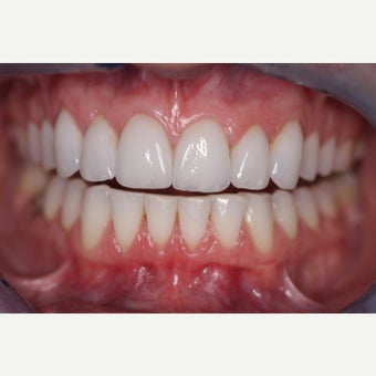 35-44 year old woman treated with Porcelain Veneers after 1833267