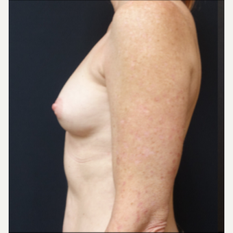35-44 year old woman treated with Breast Augmentation before 3529791