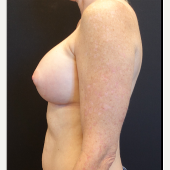 35-44 year old woman treated with Breast Augmentation after 3529791
