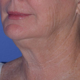 65-74 year old woman treated with Smart Lipo for Loose Neck Skin before 3154218