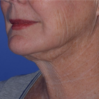 65-74 year old woman treated with Smart Lipo for Loose Neck Skin after 3154218
