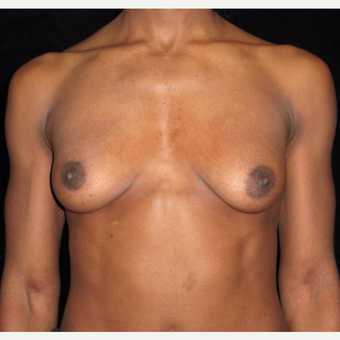 32 year old woman with asymmetry treated with Breast Augmentation before 3092536