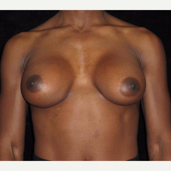32 year old woman with asymmetry treated with Breast Augmentation after 3092536