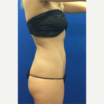 25-34 year old woman treated with Laser Liposuction after 3697099