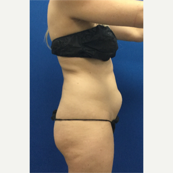 25-34 year old woman treated with Laser Liposuction before 3697099