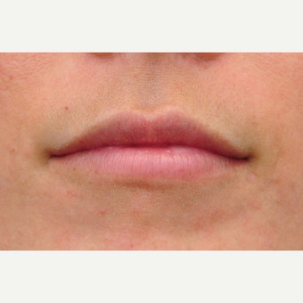 25-34 year old woman treated with Lip Augmentation after 3122276